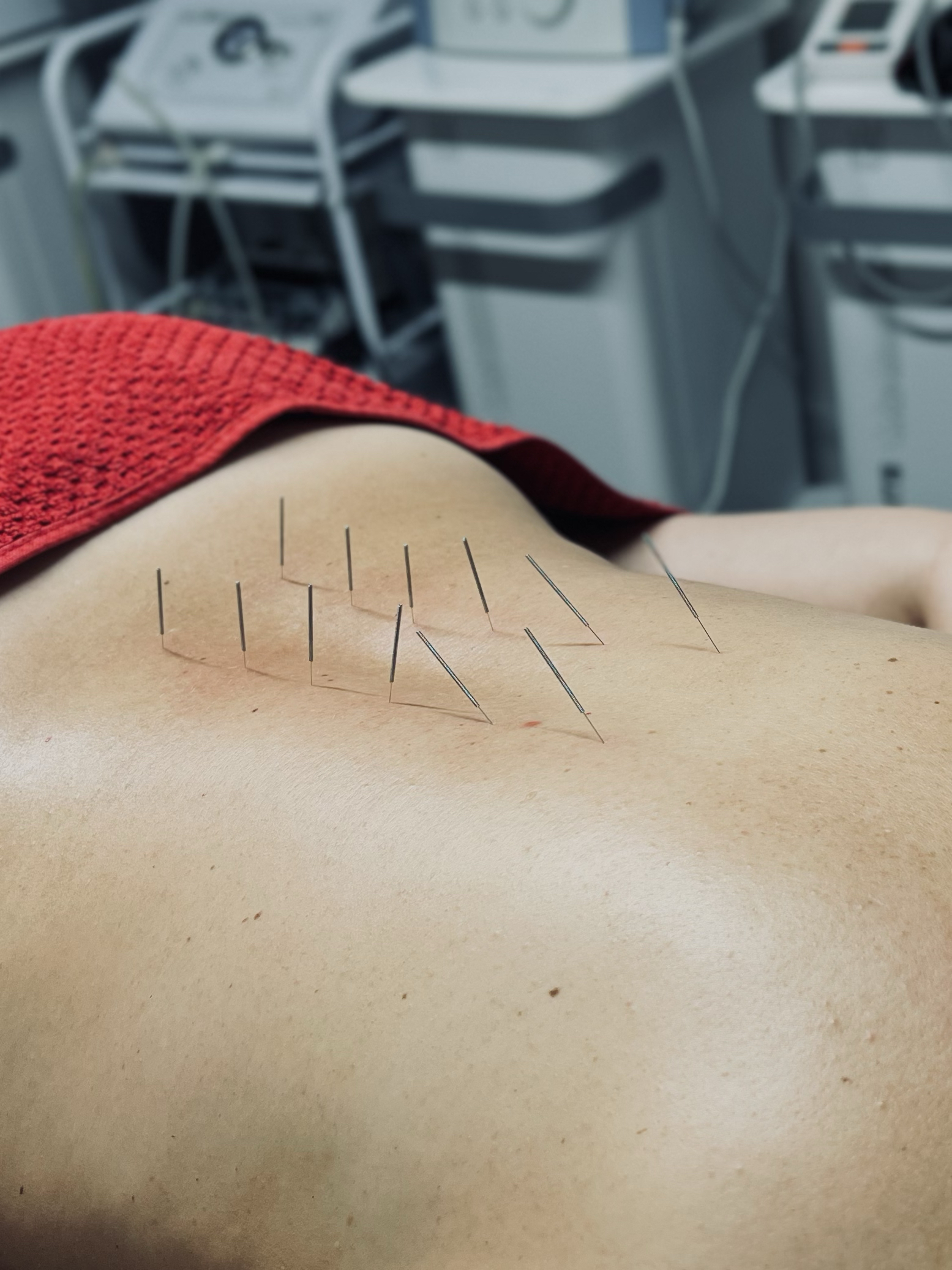 Dry Needling